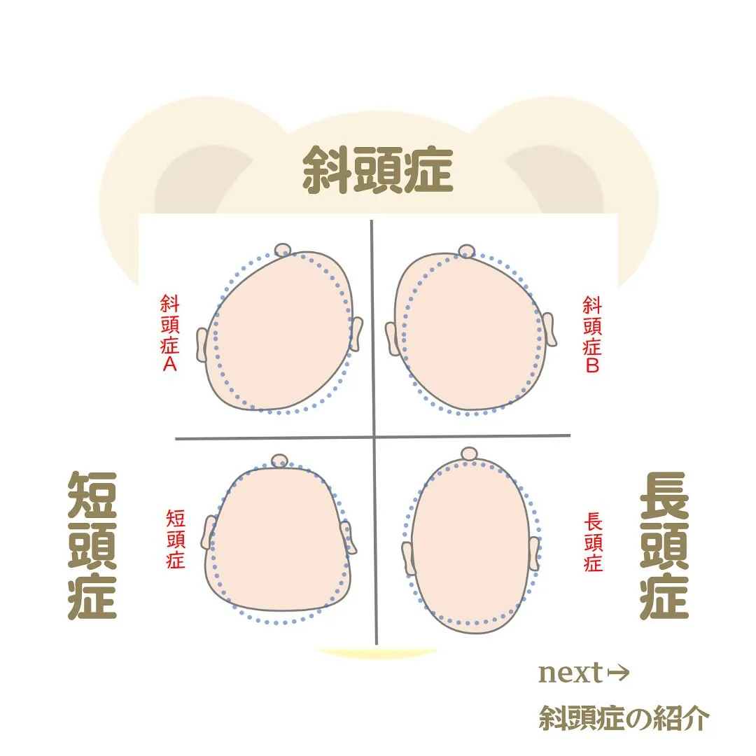 赤ちゃんの頭の形、一言で歪んでいると言っても色々あります。